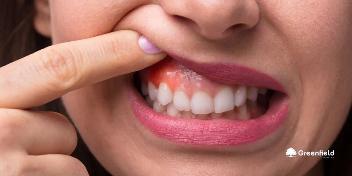 5 dấu hiệu bệnh nha chu: chảy máu lợi, hôi miệng, răng lung lay