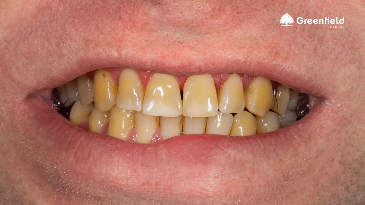 Răng xỉn màu, ố vàng: nguyên nhân và cách điều trị