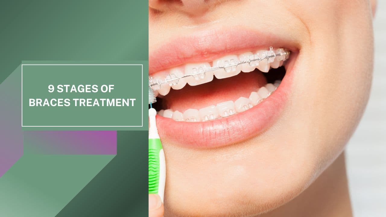 Quy trình niềng răng gồm những bước nào? 9 giai đoạn từ buổi khám đến hàm duy trì