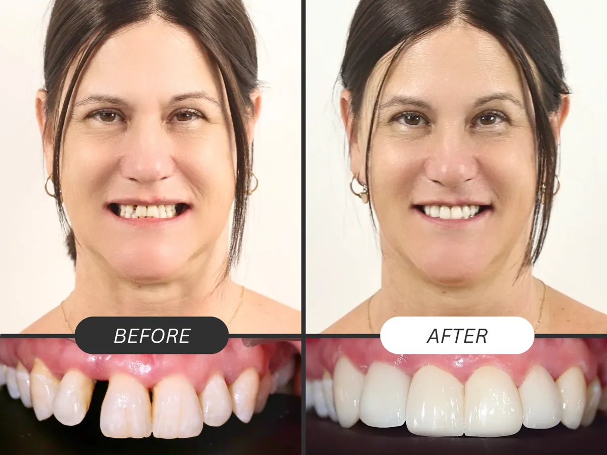 Ca dán sứ veneer 6 răng cửa tại Greenfield, trước và sau điều trị