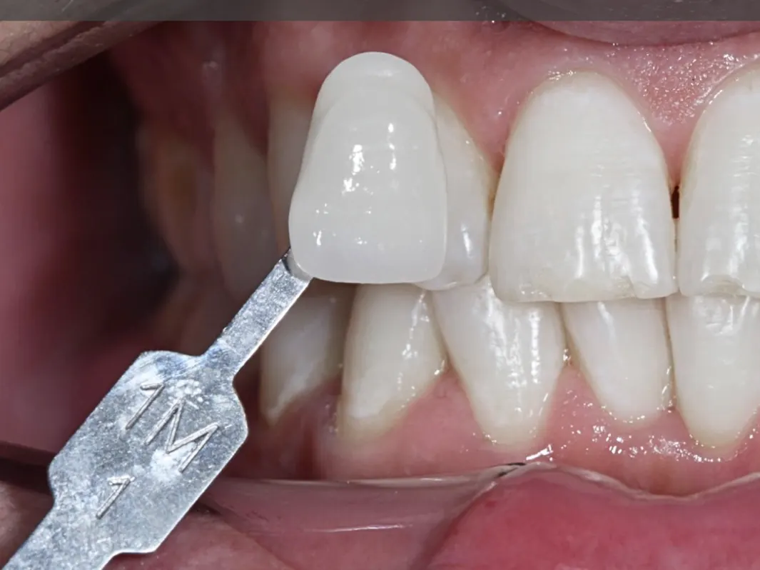 Răng sau tẩy trắng, đối chiếu bằng bảng so màu