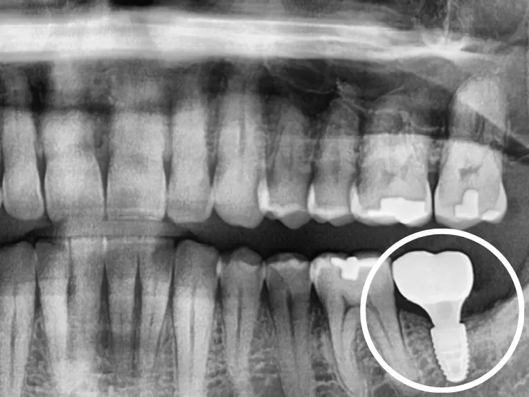Implant - Sau