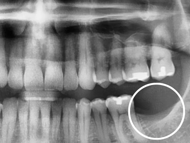 Implant - Trước