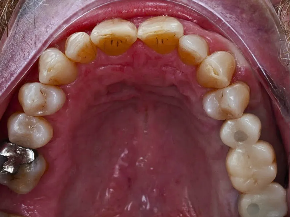 Implant - Sau