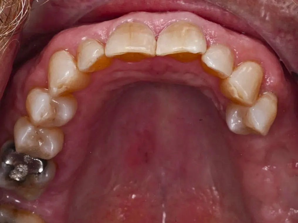 Implant - Trước