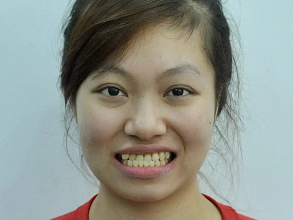 Niềng răng - Trước