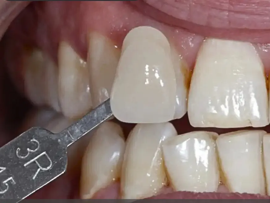 Tẩy trắng - Trước